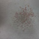 김영근의원 | 정종영. 색소침착가려움발진(色素性 癢疹, Prurigo pigmentosa). 대한임상피부관리학회 온라인저널 2019: 8