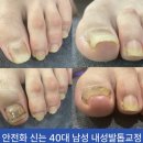 포쉬네일이마트 - 7709 | [광주 쌍촌동 네일샵] 내성발톱 통증 참지 마세요😭