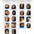아나젠 | 국내·외 연구자료로 살펴본 지방줄기세포 실제 효과, 365mc 지방줄기세포 어떻게 다를까?