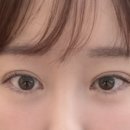 예쁜라인성형외과의원 | [디비성형외과] 강남눈재수술 후기 드디어 2달 지남! + 눈두덩이 지방이식, 눈매교정