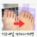닥터아이티엔&미모네일 | 독산네일 미모네일 닥터아이티엔 내성발톱 무좀발톱 발각질 문제성발 패디 후기
