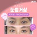 시선이머무는곳 | 강남역 눈썹거상술 비용 70만원 중년눈성형 눈썹거상술후기 궁금하면?