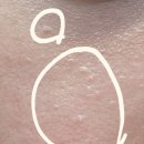 성지요양병원 | 편평사마귀 어븀야그 레이저 내돈내산 제거 후기 (편사 성지...)