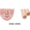 유전질환 결절성 경화증(Tuberous sclerosis) 이미지