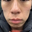 예쁨주의쁨의원 | 내돈내산 노원피부과 필로드 리쥬란 대신 선택한 이유 예쁨주의쁨의원