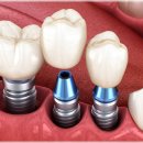 은평장수플란트치과의원 | 은평구임플란트 치과 고민되고 있다면