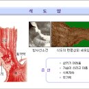 식도암 이미지