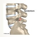 척추 분리증 spondylolysis[척추 협부 결손] 이미지