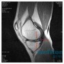 무릎연골파열 치료 @관절내시경이란~~~~~~~ 이미지
