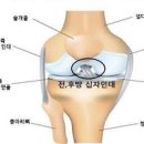 십자인대파열 원인 증상 치료 십자인대파열 재활운동 전방 후방 십자인대 이미지