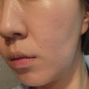 브이티브이오 | 2편｜복합 레이저 치료(울트라펄스알파, 피코프락셀, 프락스프로, 쥬베룩, 미라젯 등) 8회 내돈내산 후기