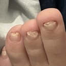자명약국 | 발톱무좀약 주블리아 가격 8ML 관리 후기