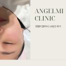 엔젤미의원 | 압구정 엔젤미 슈링크 300샷 , 자주가게되는 솔직 후기! (feat. 붓기, 유지 기간)