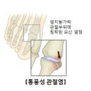 통풍 이미지