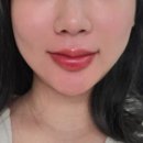 거의로 | 코조각주사 + 콧볼보톡스 2차후기, 웃어도 코 벌렁거림 거의 없음 사라짐