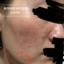 양산달약국 | 최근 1년 피부 근황-1편(해외여행 중 접촉성피부염, 급성 습진, 스테로이드 주사+약 복용 후기)