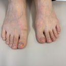 추새로병원 | 이천 내성 발톱무좀 심해지는 통증 간단히 해결한 후기