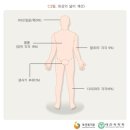 중대 화상·부식 진단비 특별약관(중대 화상·부식의 정의 및 진단확정) 이미지