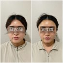 두찜 | 얼굴 작아지는 대구 윤곽관리 하우라 하이윤곽관리 후기