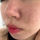 정은 에스테틱 | 송도피부관리 여드름압출 빛나래에스테틱 트라이엄 후기