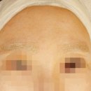 이수역 | 이수역 피부과 티타늄리프팅 내돈내산 후기