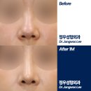 [복코 성형 1개월 차 전문의 리뷰] 과교정을 피하는 섬세한 연골묶기와 코끝 디자인의 중요성