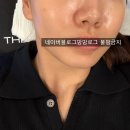엔파로 | 엔진리프팅 피부 속근육부터 관리하는 잠실피부과 페이스피트니스 후기 ✨