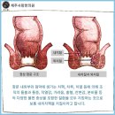 나만 아는 고통 치질, 비수술 한방치료로 해결하세요. 이미지