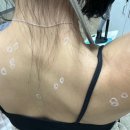 메이퓨어의원마포공덕점 | 메이퓨어 공덕점 ) 점 제거 500원!! 내돈내산