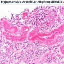 고혈압성 신장 질환[hypertensive nephropathy] 이미지