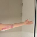 소망속옷 | [결혼준비] 지방제거시술 무한람스 1일차 후기 (팔뚝/등)