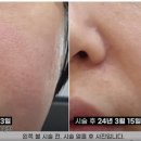 (주)코리아세븐 반포서래마을점 | 포텐자 펌핑팁 모공 여드름흉터 치료효과 쥬베룩 볼륨 엑소좀 콜라보 닥터지니 경험담 강남피부과 신사...