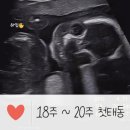 정평봄산부인과의원 | 또복이..❤ 18주 ~ 20주, 첫 태동, 갈색혈 출혈 이슈*