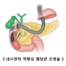 만성 췌장염9Chronic pancreatitis) 소화기 질환이란? 이미지