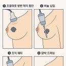20대, 유방 미세석회 조직검사 후기