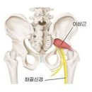 엉덩이 통증 원인과 방법 이미지