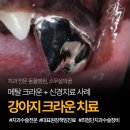 크라운 동물병원 | 강아지 크라운 치료 후기, 신경치료까지 동반했던 아이