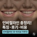박영민치과의원 | 인비절라인 특징·후기·가격 총정리! 투명교정 완벽 가이드 / 강남역 교정치과 강남레옹치과