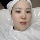 하단 달리핀 에스테틱 : 기미 레이저 후기 (7일차 경과)