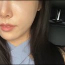 멍블링 | 실리프팅 유지기간 후기 멍 부작용 가격 (+꿀팁)