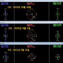 에이에스메디칼 | 13살여자아이 평발교정후기 - 평발교정센터와 함께 쌓아 올린 평발교정의 작은 희망 진행중