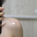 명이의료기기 | 켈로이드 흉터 관리템, 더마에스씨 플러스 패치 직접 사용해 본 후기