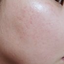에이씨티클리어 남보라톡톡이 붉은자국변화 사진후기
