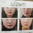 (주)디자인투맨 | 비너스 달걀주사로 볼살 & 처진 얼굴 리프팅 후기