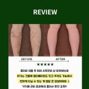 루이샤의원 | 🚨종아리 지흡 후 이 상태면, 방치 시 그대로 굳습니다