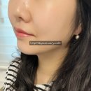 피부탱탱 | 천안 올타이트 리프팅 후기 피부가 탱탱해지고 착붙 라인이 정리되는 느낌