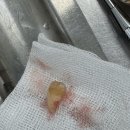 가인치과의원 | 사랑니 2개 이틀 연속 뽑은 후기 — 점심시간에 뽑고 바로 출근했습니다