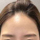 미미헤어라인 이미지