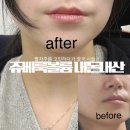 볼륨 | 부산피부과 쥬베룩볼륨 내돈내산 리얼후기