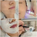 엘레나베이커리 | 간석동 에스테틱 엘레나이젠 여름 피지잡는 진정케어 피부관리 전후